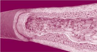 残余血脂异常显示动脉内部充满斑块
